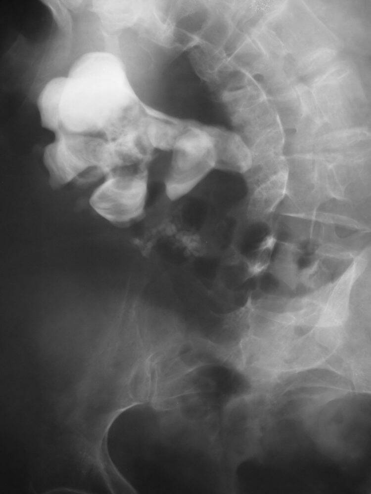 Sering Tak Bergejala, Kenali ‘Staghorn Stone’